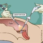 Laparoscopy Surgery Specialist